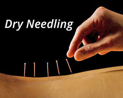 Dry Needle